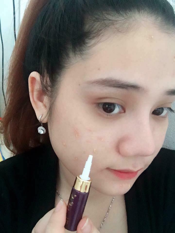 Kem trị mụn Huyền Cò