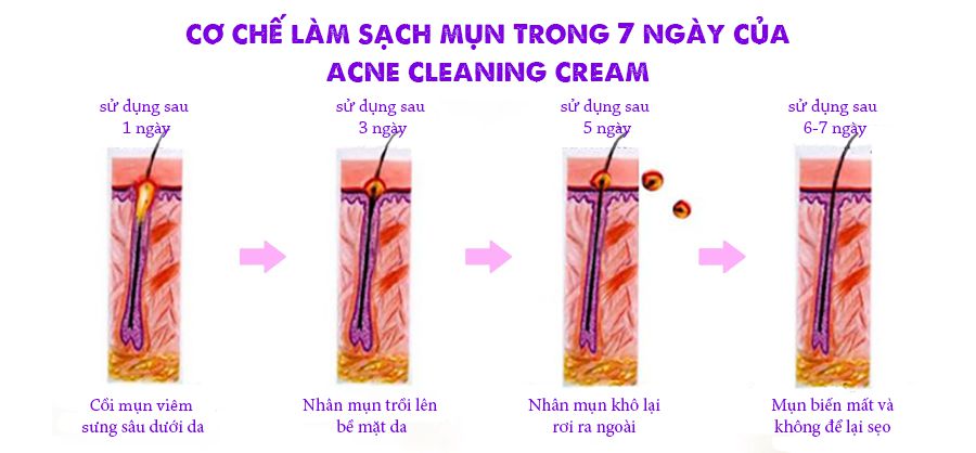 Kem trị mụn ACNE Huyền Cò